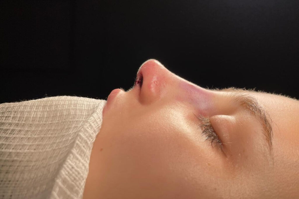 Cirurgia estética nasal em Florianópolis