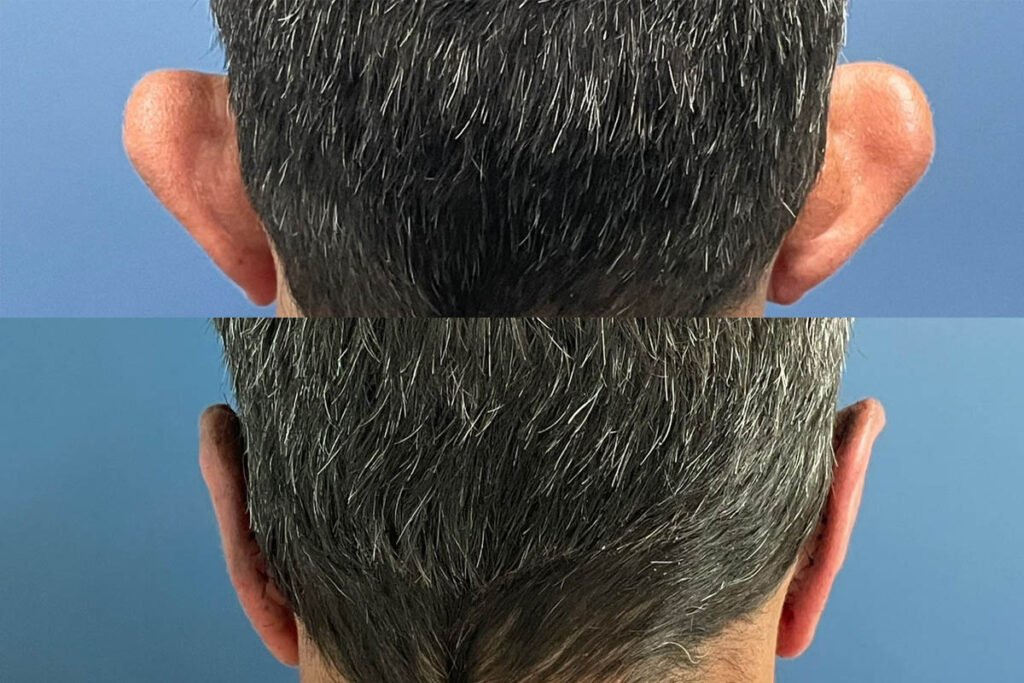 Otoplastia em Florianópolis