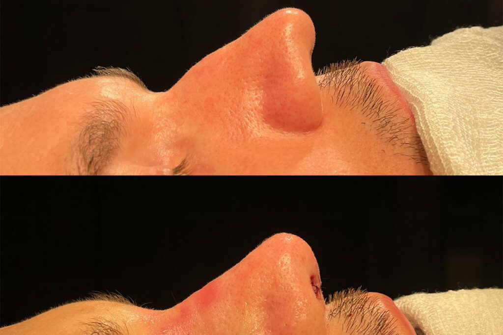 Rinoplastia com cartilagem costal em Florianópolis