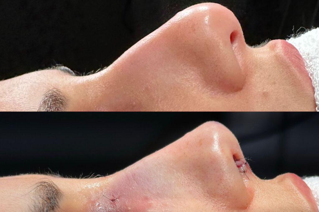 Rinoplastia em Florianópolis