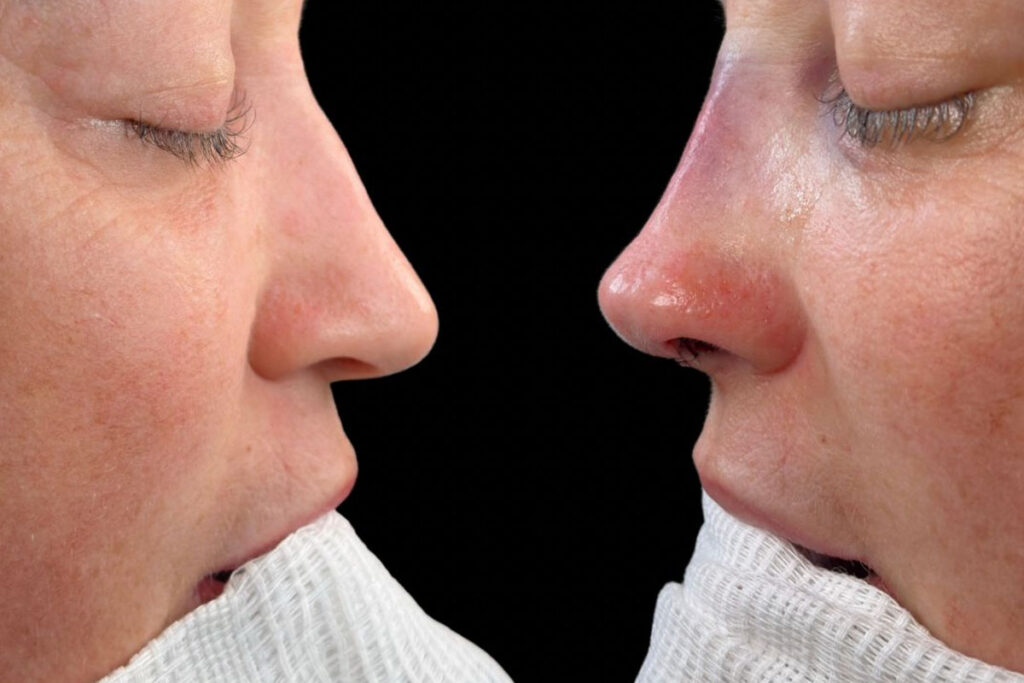 Rinoplastia estruturada em Florianópolis