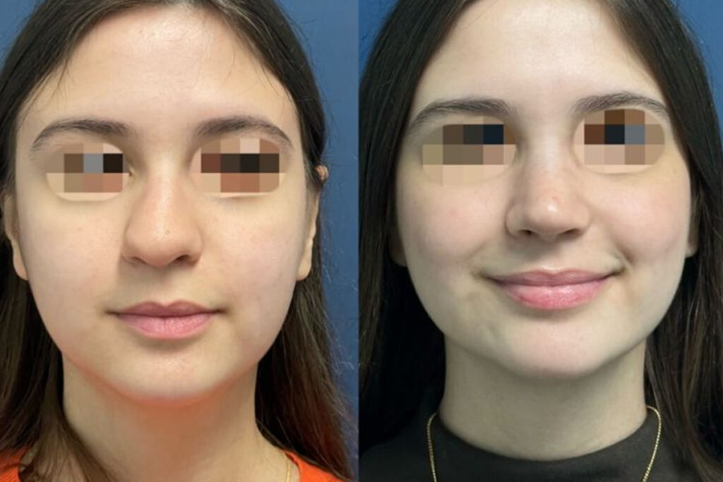 Rinoplastia híbrida em Florianópolis