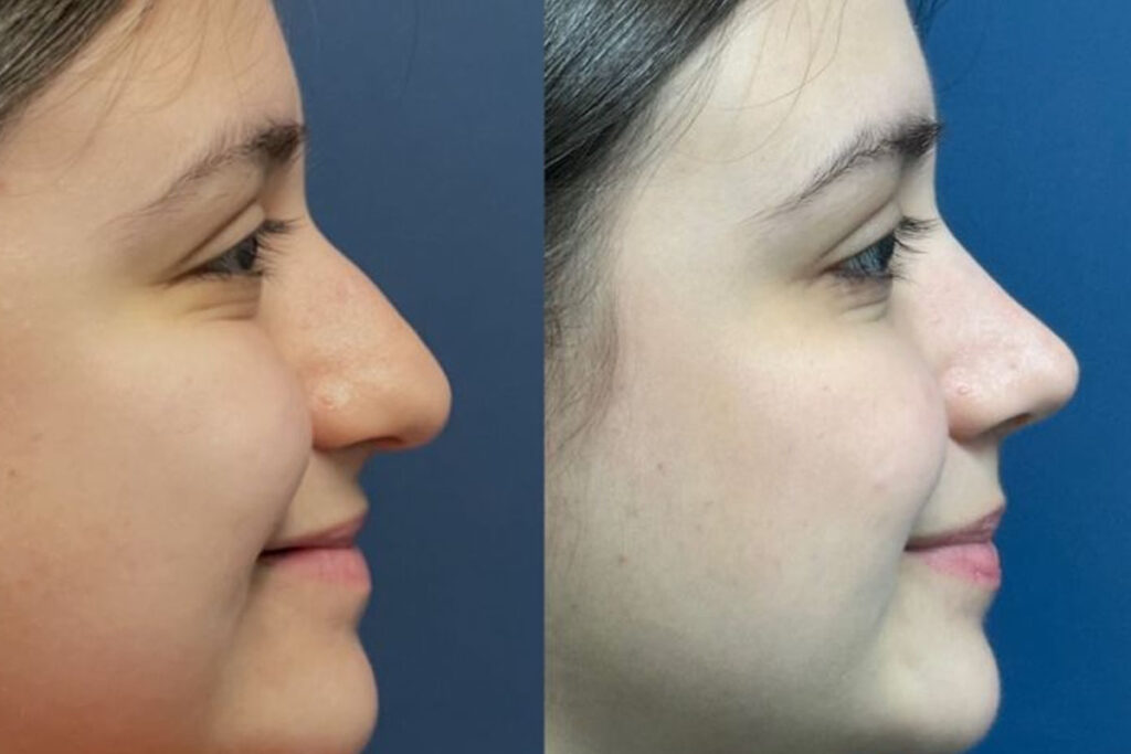 Rinoplastia preservadora em Florianópolis