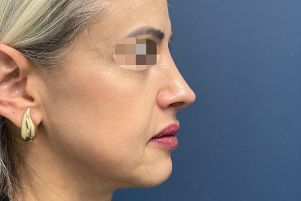 Rinoplastia revisional em Florianópolis